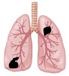 肺がんのイメージイラスト